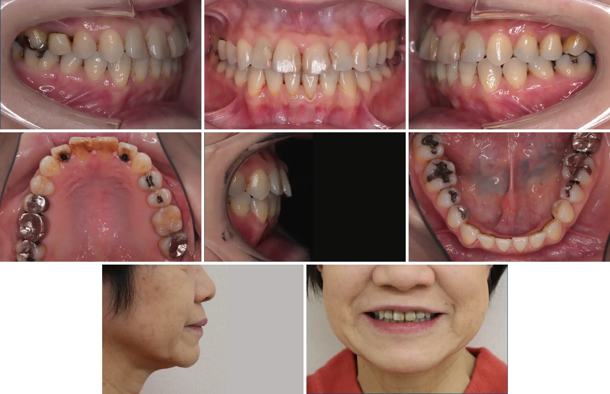 治療後(1年9ヶ月後)