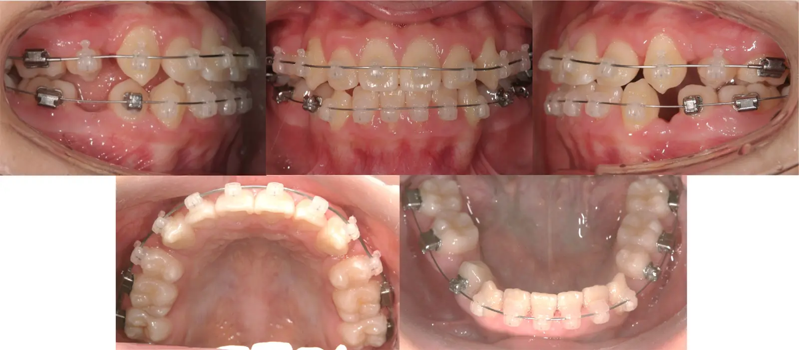 治療中（2ヶ月を使用）