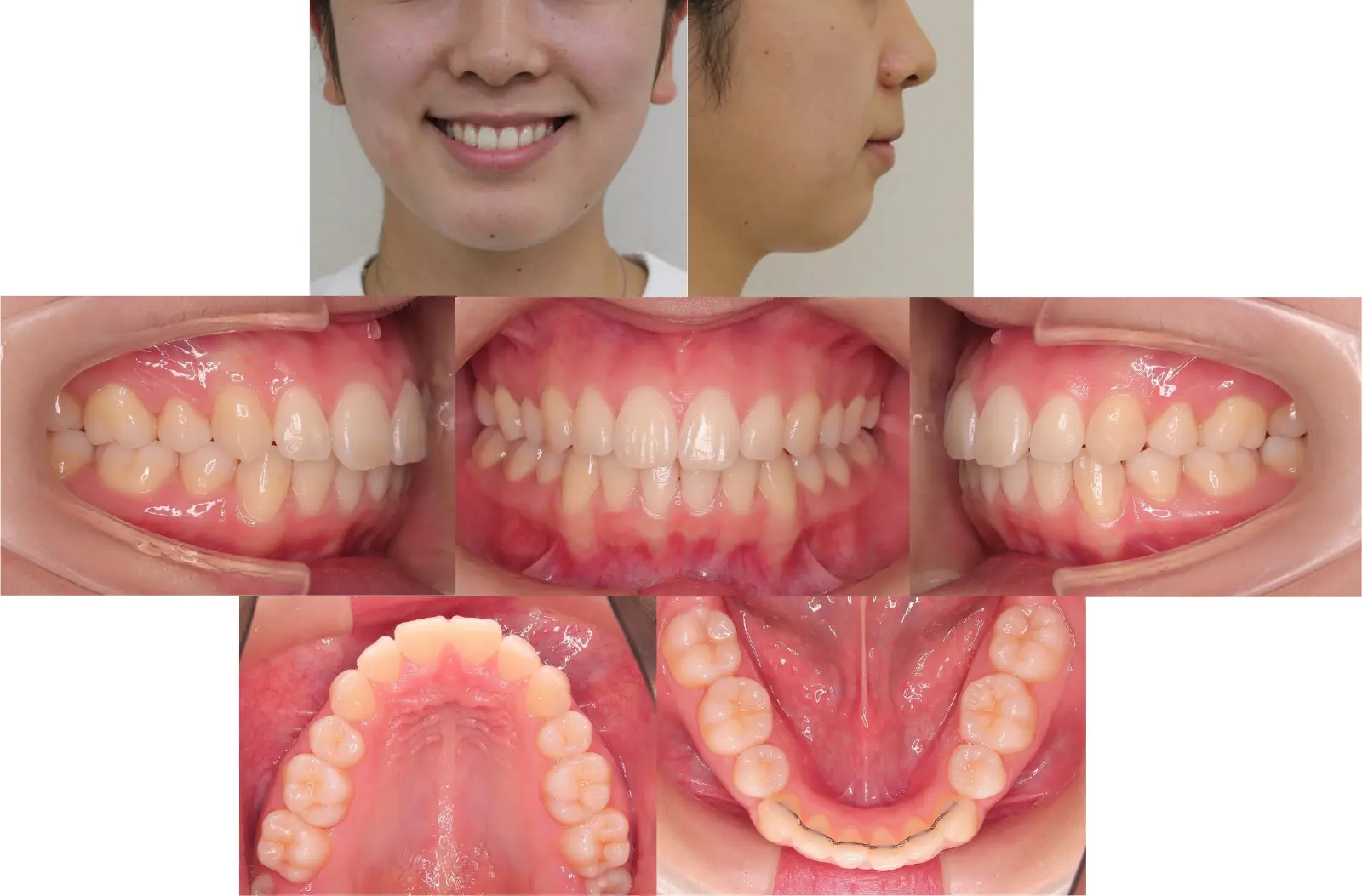 治療4年7ヶ月後