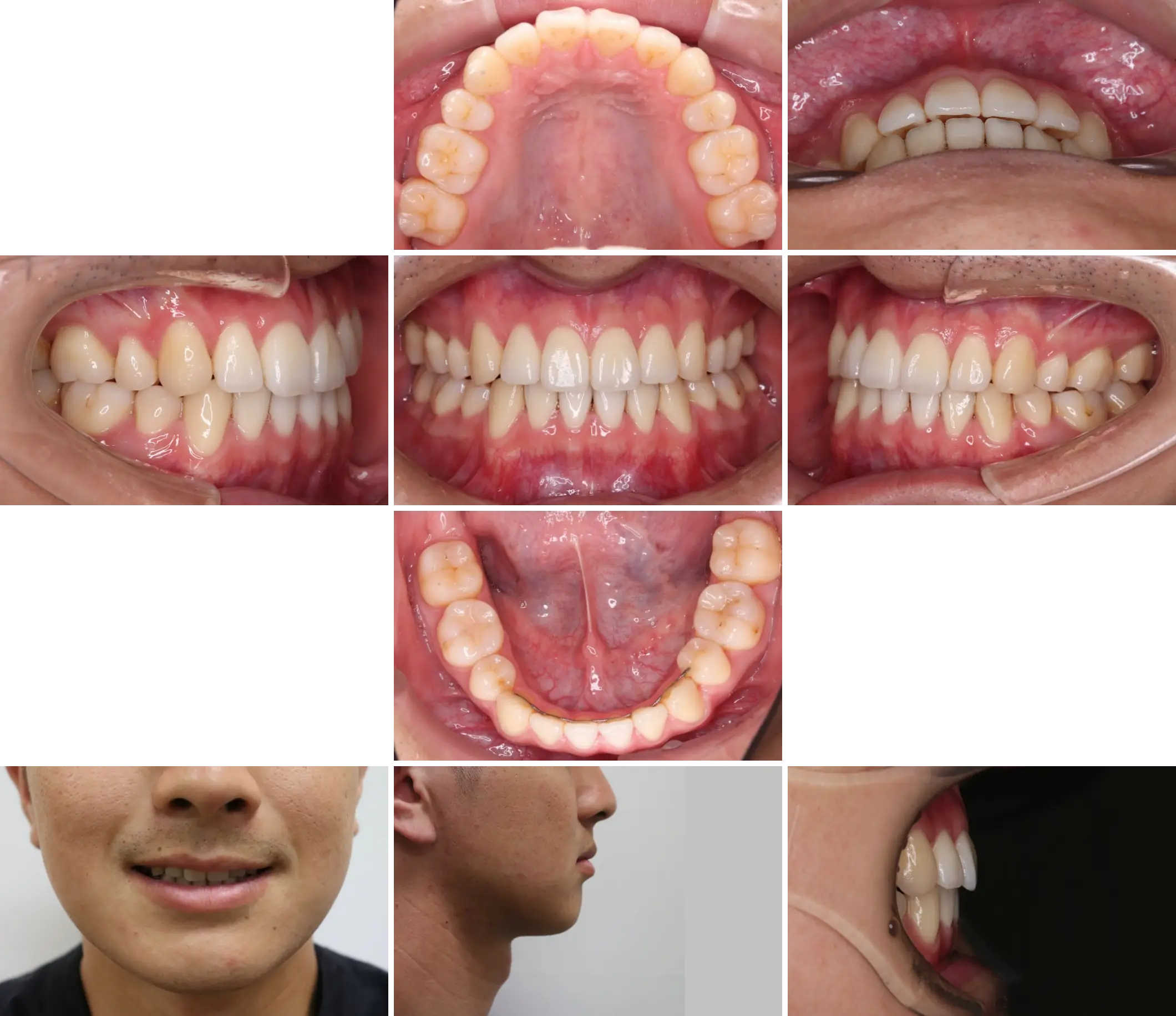 治療後（2年7ヶ月後）