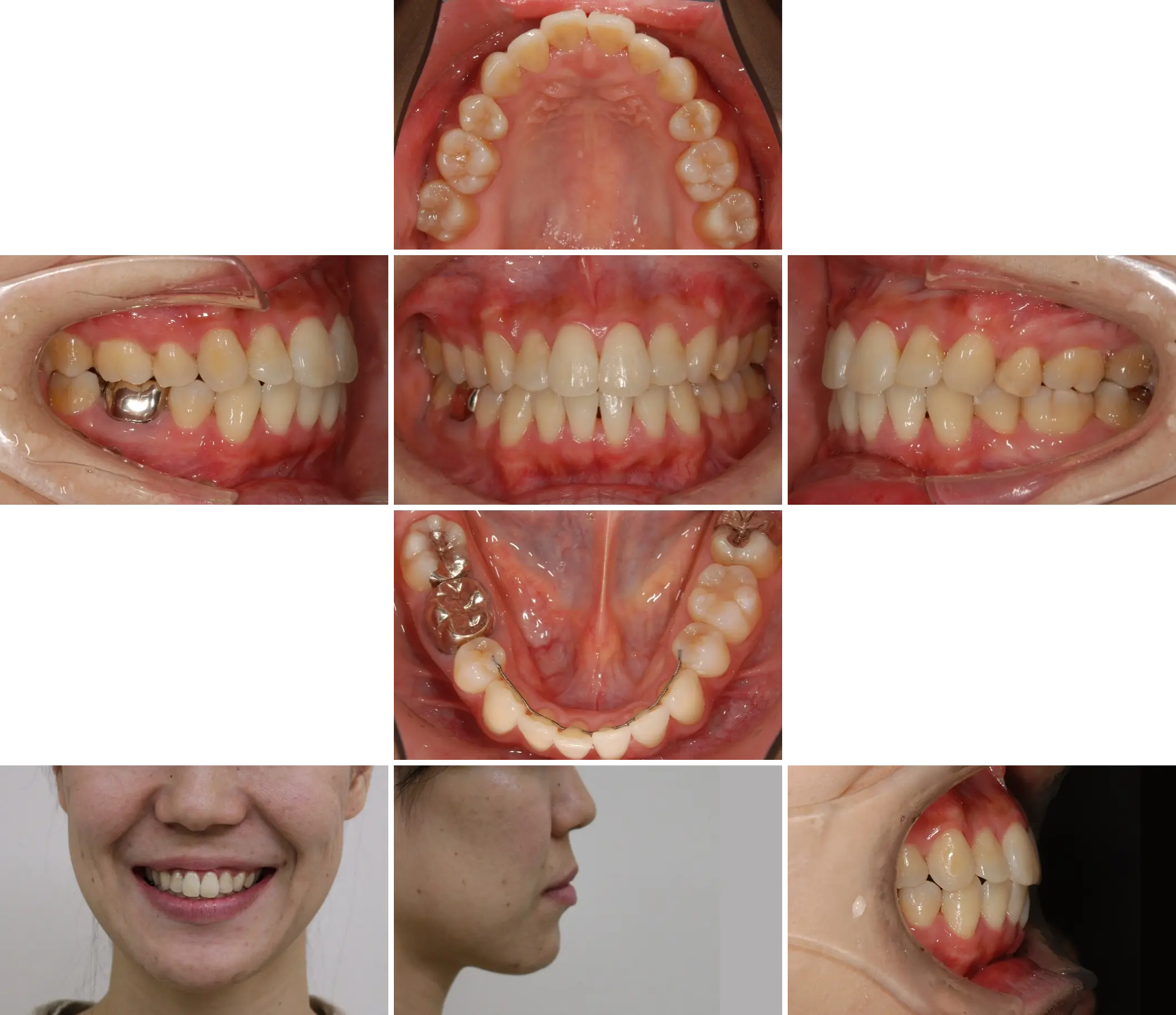 治療後（7年5ヶ月後）