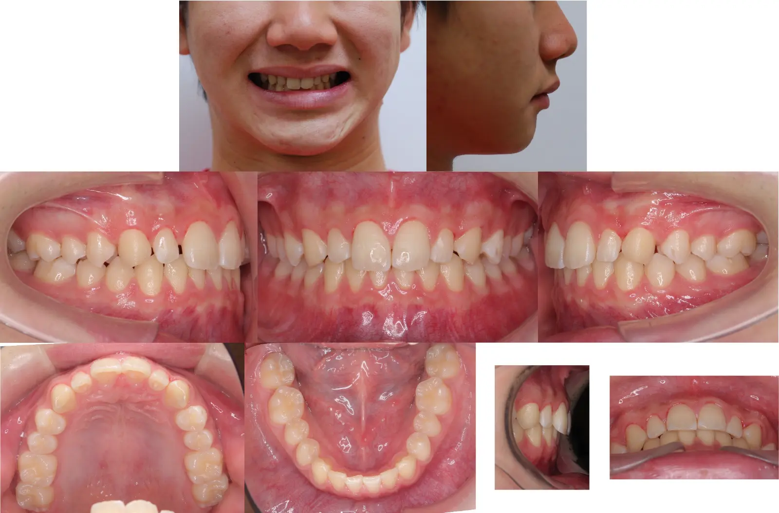 第1段階治療9年2ヶ月後