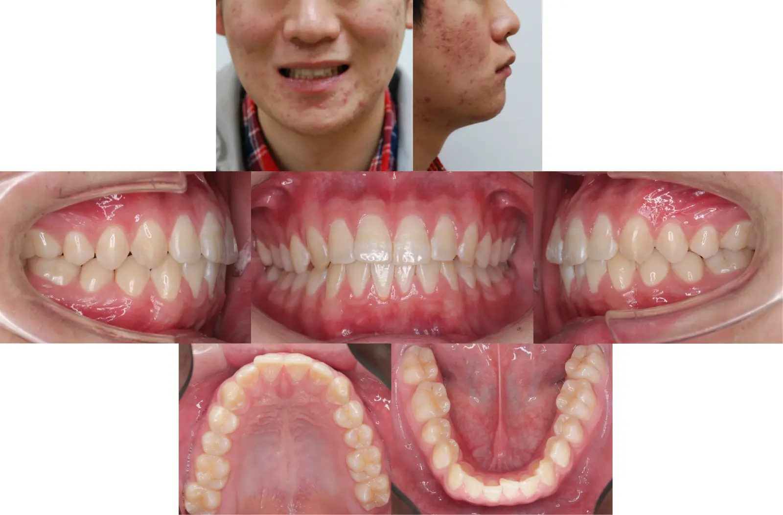 第1段階治療9年6か月後