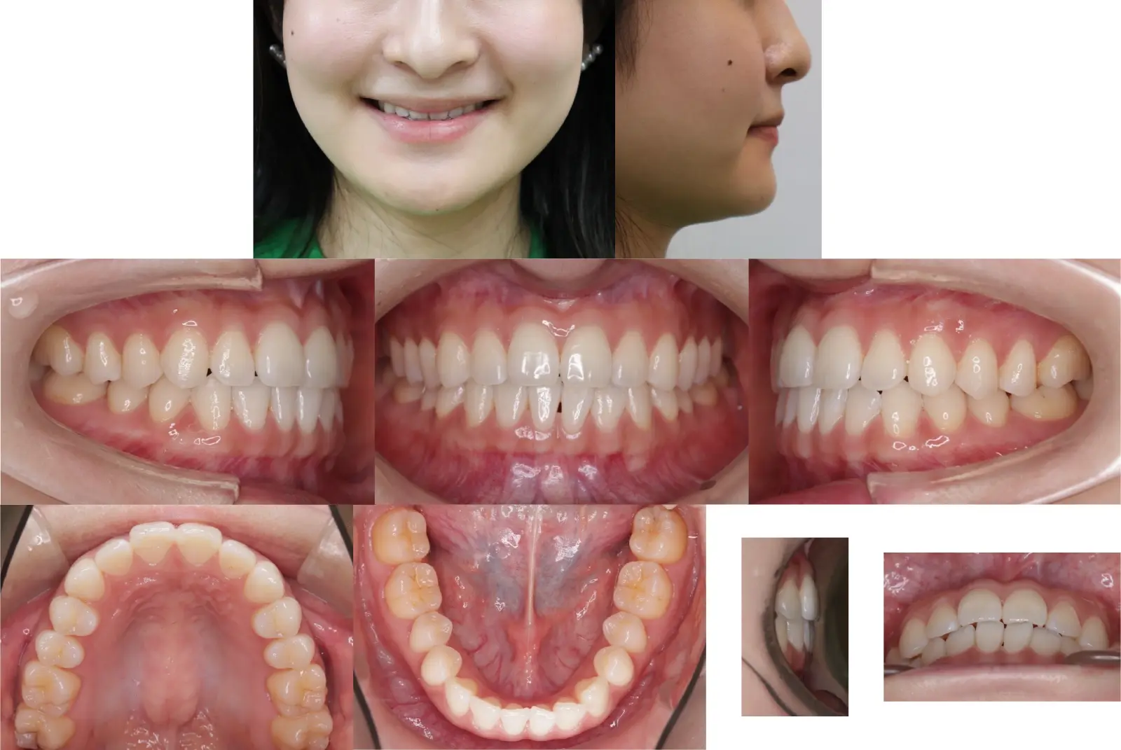 第1段階治療17年6ヶ月後