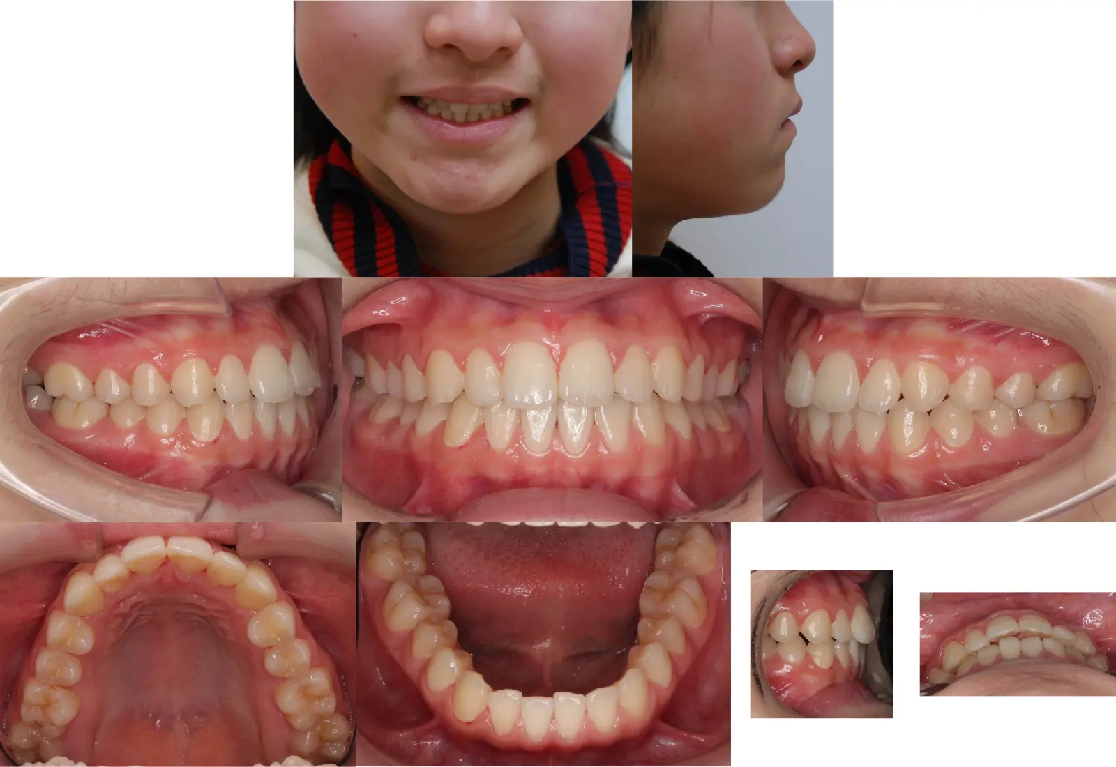 第1段階治療4年5ヶ月後