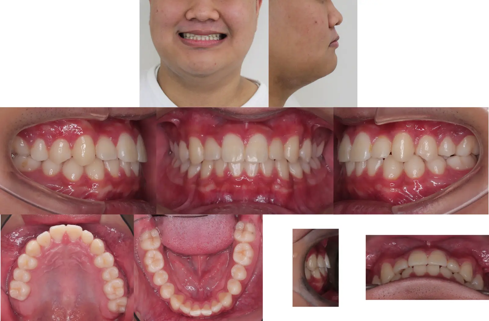 第1段階治療4年5ヶ月後