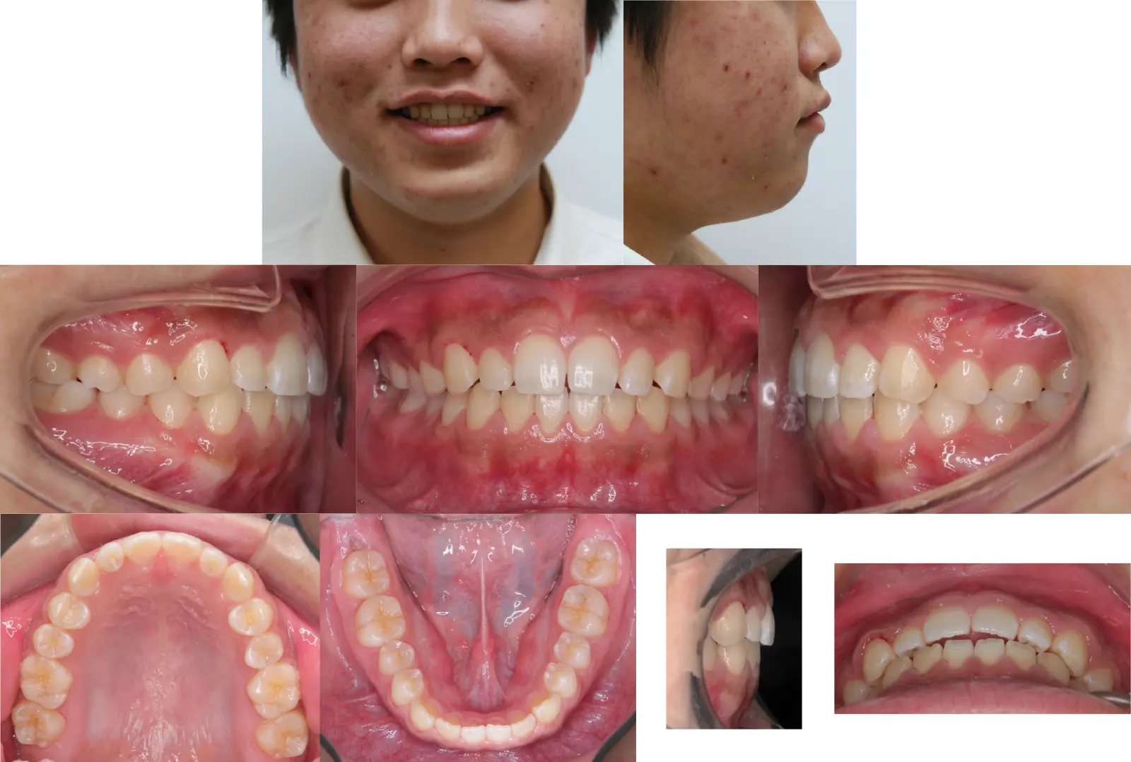 第1段階治療6年1ヶ月後