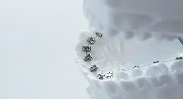 舌側矯正