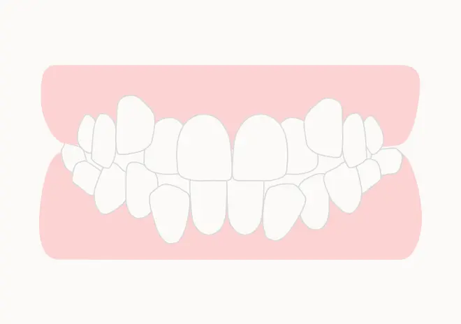 叢生(八重歯・乱ぐい歯)