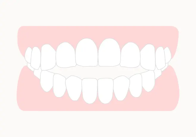 開咬(オープンバイト)