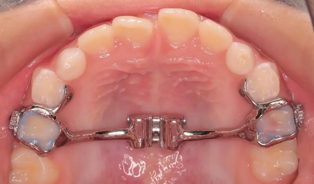 TAT（Transpalatal Arch：タット）